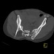 Fracture of pelvis, pubic bone, subluxation of sacrum: CT - Computed tomography